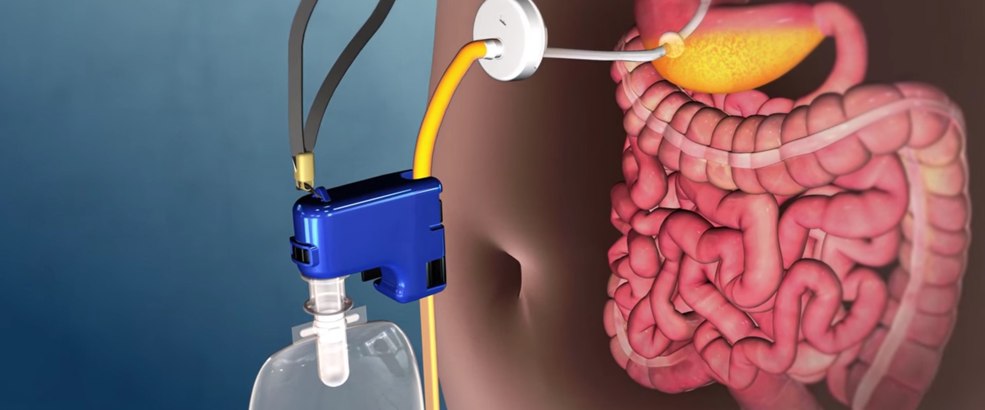 Gastric Band Surgery for Medical Weight Loss
